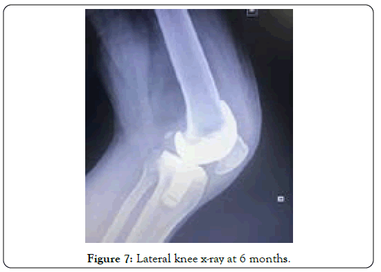 tuberculous-arthritis-diagnosed-x-ray-at-6-months