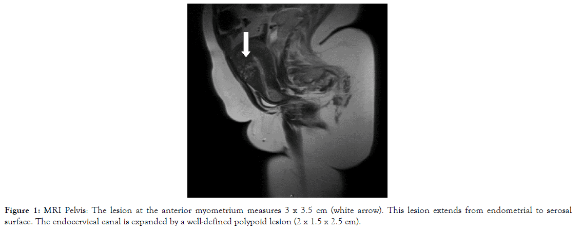 womens-health-care-anterior-myometrium