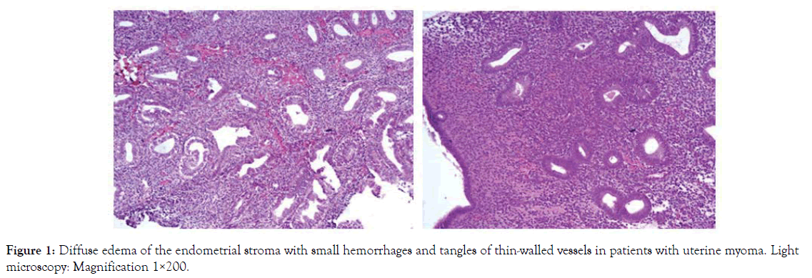 womens-health-care-endometrial-stroma