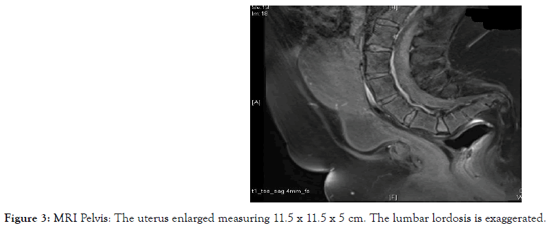 womens-health-care-uterus-enlarged-measuring