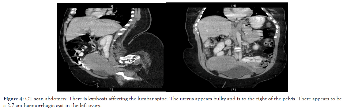 womens-health-care-uterus-haemorrhagic-cyst