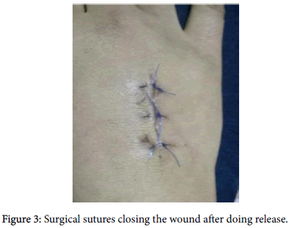 clinical-trials-Surgical-sutures