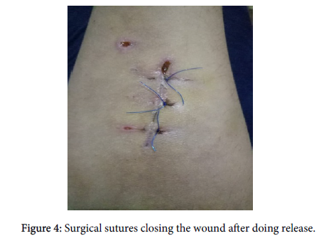 clinical-trials-Surgical-wound