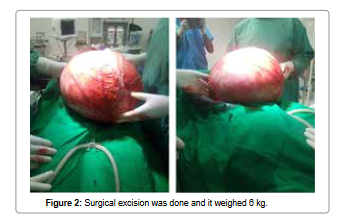 clinical-trials-Surgical-excision