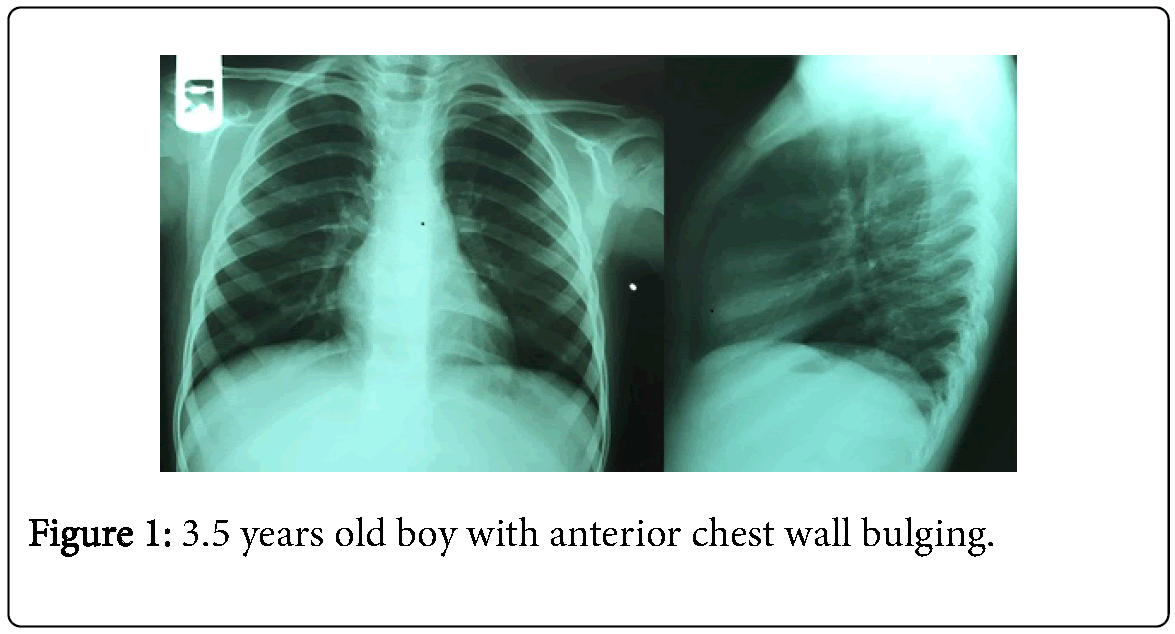Leukemia-3.5-years-old-boy-anterior-chest-wall-bulging