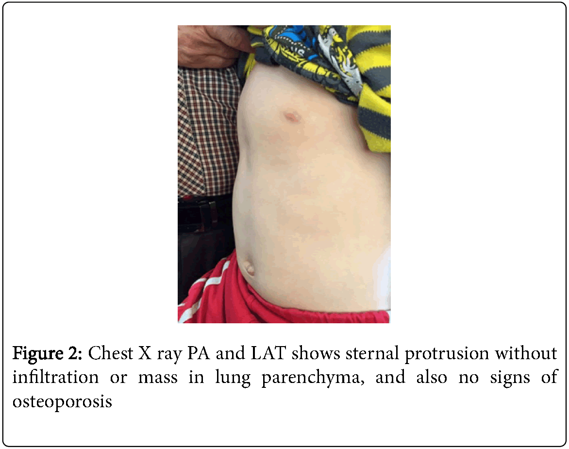 Leukemia-Chest-X-ray-PA-LAT-shows-sternal-protrusion