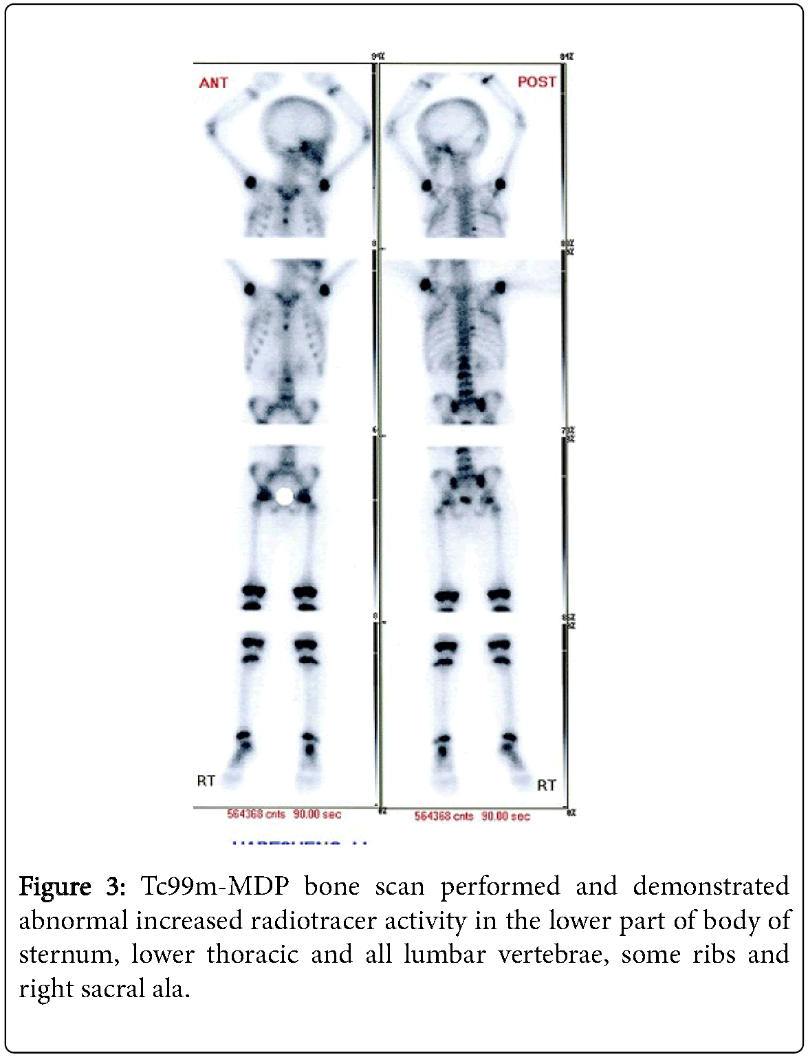 Leukemia-Tc99m-MDP-bone-scan-performed-demonstrated