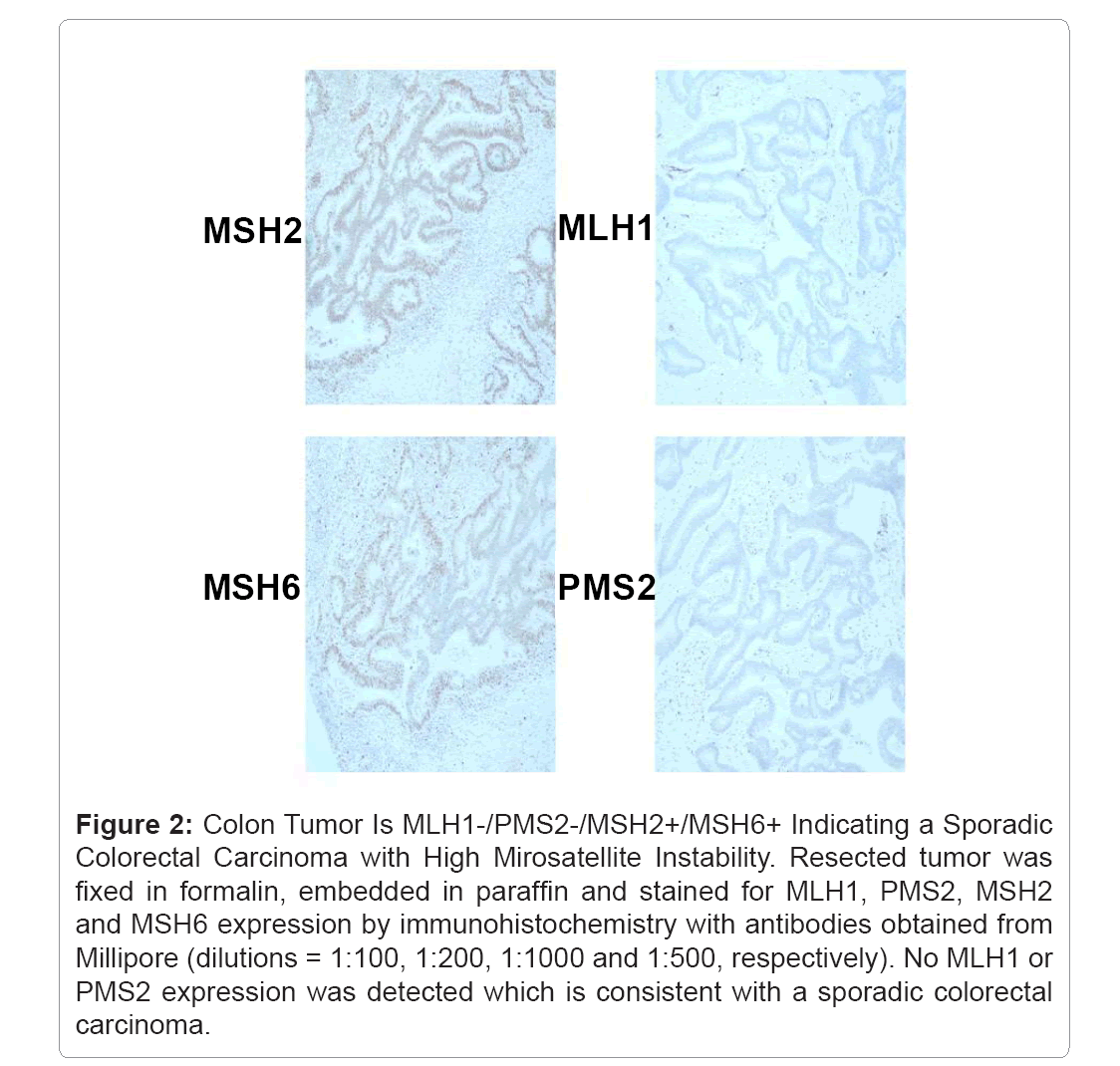 Thromboembolic-Diseases-Colon-Tumor-MLH1-PMS2-MSH2-MSH6-Indicating-Sporadic