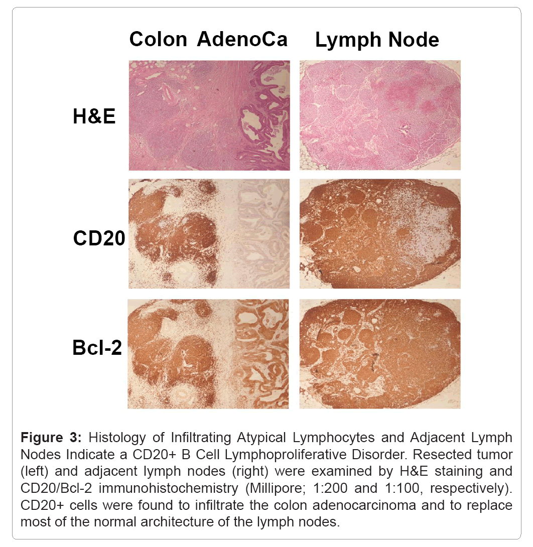 Thromboembolic-Diseases-Histology-Infiltrating-Atypical-Lymphocytes-Adjacent-Lymph