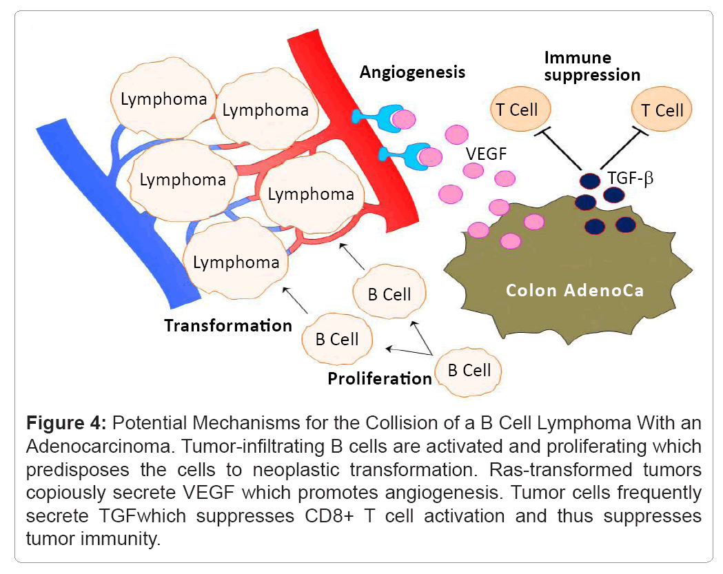 Thromboembolic-Diseases-Potential-Mechanisms-for-Collision-B-Cell-Lymphoma