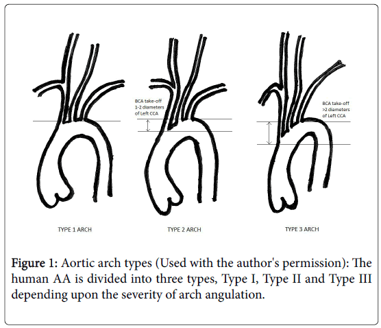 anatomy-physiology-Aortic-arch-types