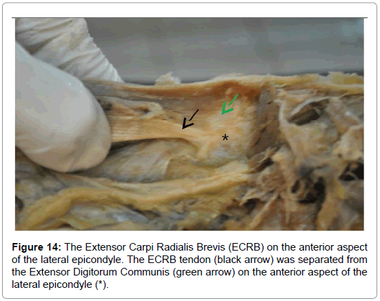 anatomy-physiology-ECRB-tendon