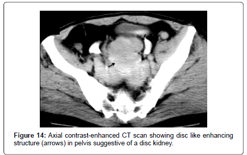 anatomy-physiology-disc-kidney
