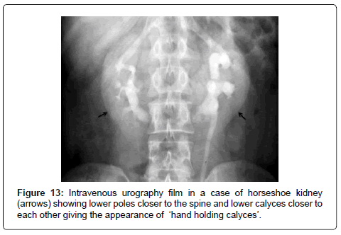 Horseshoe kidney, Radiology Reference Article