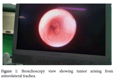 anesthesia-clinical-research-Bronchoscopy