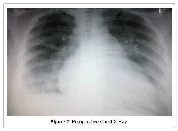 anesthesia-clinical-research-Chest-X-Ray