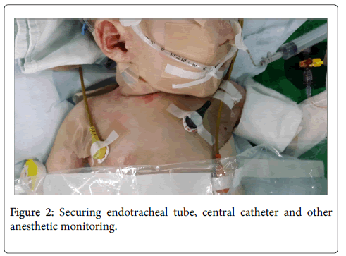 anesthesia-clinical-research-Securing-endotracheal