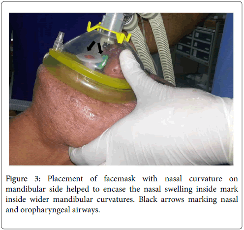 anesthesia-clinical-research-facemask-nasal-curvature