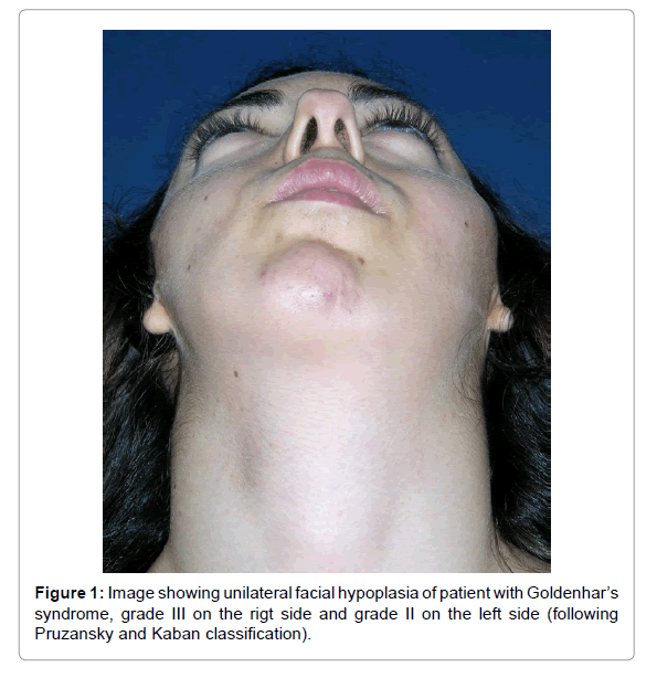 anesthesia-clinical-research-facial-hypoplasia