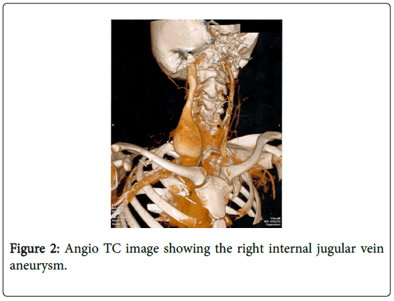 angiology-Angio-TC-image-right-internal