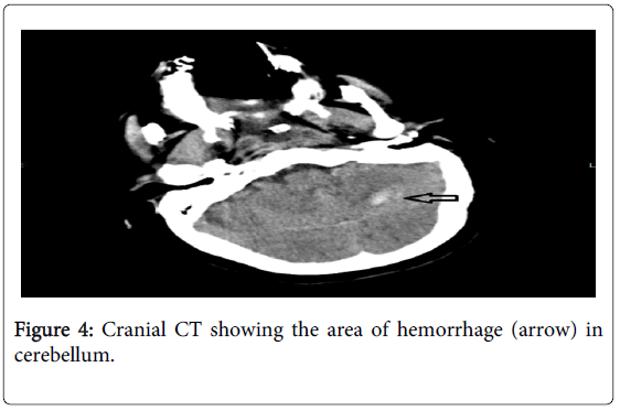 angiology-Cranial-CT-showing-hemorrhage
