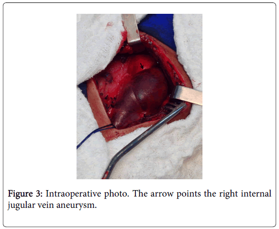 angiology-Intraoperative-photo-arrow-points
