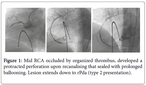 angiology-Mid-RCA-occluded