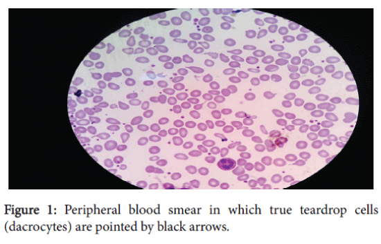 archive-bone-marrow-research-Peripheral-blood