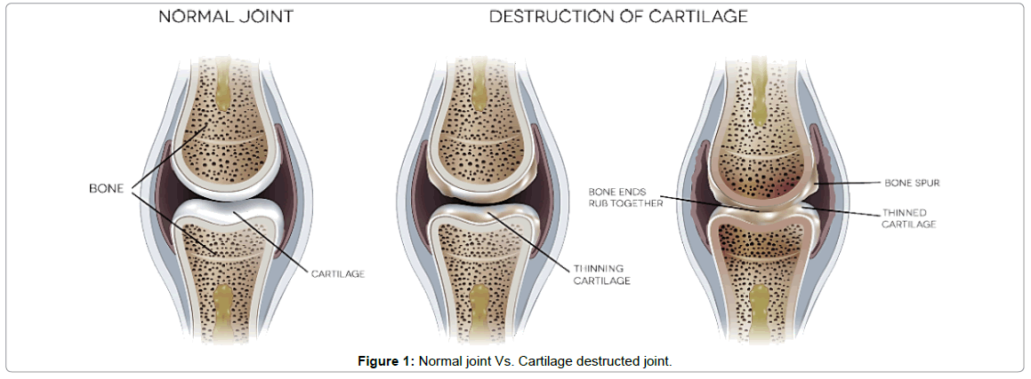 bone-marrow-research-Cartilage-destructed-joint
