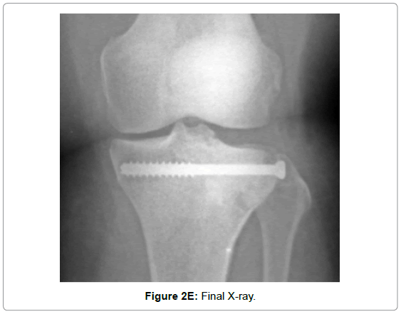 bone-marrow-research-Final-X-ray