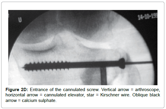 bone-marrow-research-cannulated-screw