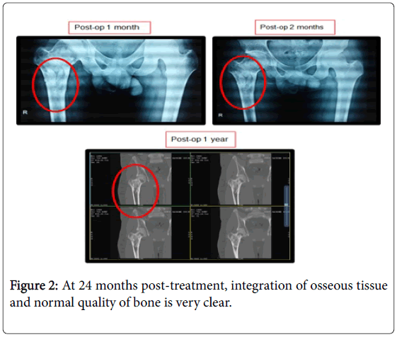 bone-marrow-research-post-treatment-integration