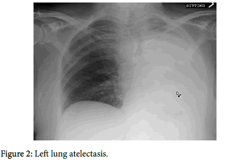 cancer-science-and-research-Left-lung-atelectasis