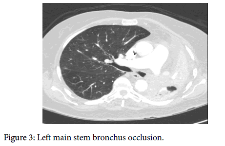 cancer-science-and-research-Left-main-stem-bronchus-occlusion