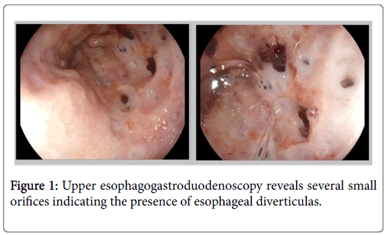 cancer-science-and-research-esophageal-diverticulas