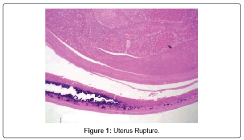 cell-science-therapy-Uterus-Rupture