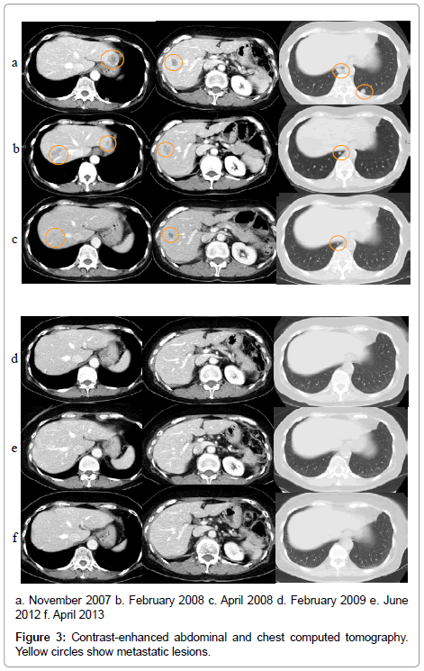 chemotherapy-Contrast-enhanced-abdominal