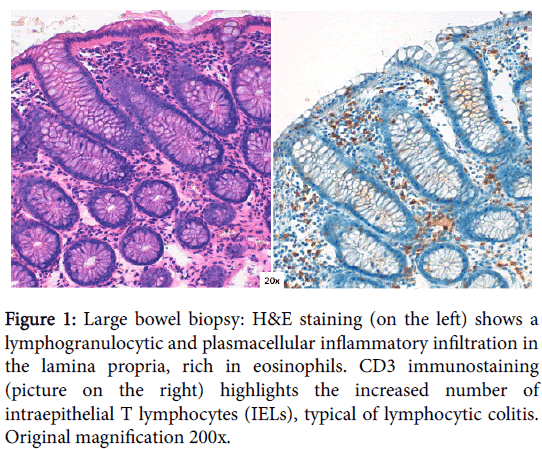 clinical-cellular-immunology-Large-bowel-biopsy