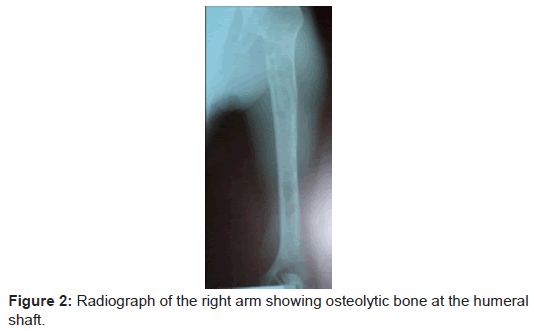clinical-cellular-immunology-Radiograph-right-arm