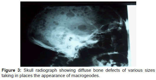 clinical-cellular-immunology-diffuse-bone-defects