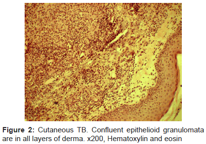 clinical-cellular-immunology-epithelioid-granulomata
