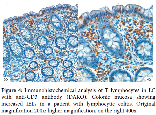 clinical-cellular-immunology-lymphocytic-colitis