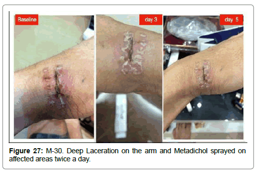 clinical-dermatology-Deep-Laceration