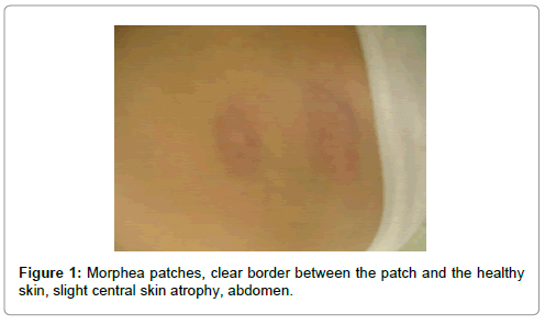 Localised Scleroderma Patchy Type Morphea