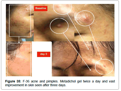 clinical-dermatology-Pimples-acne