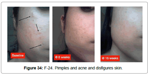 clinical-dermatology-Pimples-skin