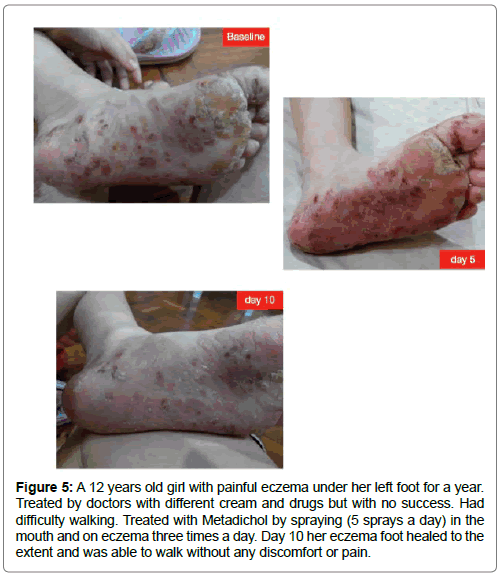 clinical-dermatology-painful-eczema