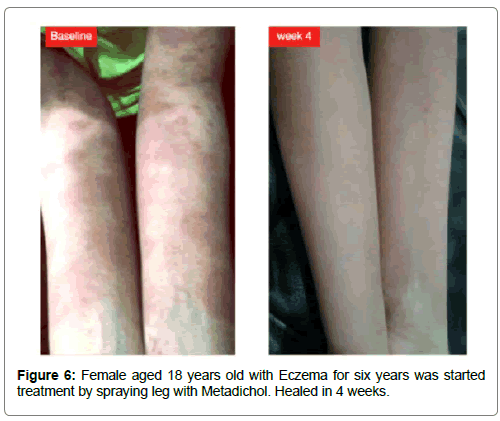 clinical-dermatology-spraying-leg