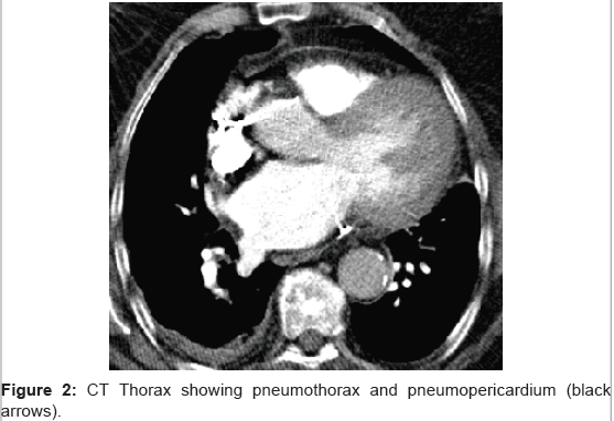 clinical-experimental-cardiology-CT-Thorax-pneumothorax