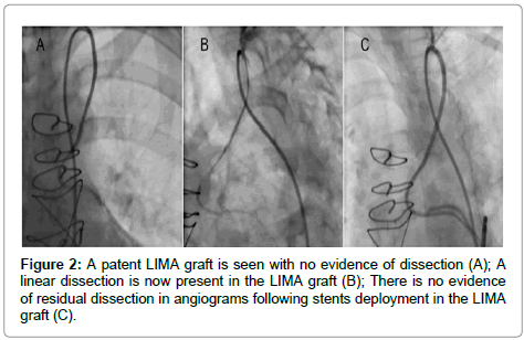 clinical-experimental-cardiology-LIMA-graft